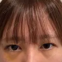下まぶたの脂肪取り 聖心美容クリニック 福岡院 AFTER サムネイル用