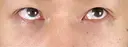 クマ治療 藤・ナチュレ美容クリニック 銀座院 DAY 0 サムネイル用