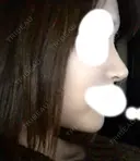 隆鼻術 / 鼻尖形成（切開） / 鼻中隔延長（切開） / 鼻尖縮小 FROM B整形外科 (旧バウム整形外科) DAY 270 サムネイル用