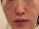 リジュラン 麻布十番クレールデンタルクリニック DAY 2 サムネイル用