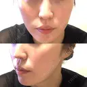 RF（高周波）たるみ治療 / オリジオ muni skin clinic DAY 0 サムネイル用