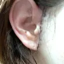 切開リフト GRACY TOKYO CLINIC【グレイシートウキョウクリニック】 AFTER サムネイル用