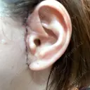 切開リフト GRACY TOKYO CLINIC【グレイシートウキョウクリニック】 DAY 8 サムネイル用