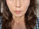 糸リフト / ヒアルロン酸注入（頬） / ヒアルロン酸注入（こめかみ） ルラ美容クリニック 新潟院 DAY 6 サムネイル用