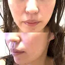 RF（高周波）たるみ治療 / オリジオ muni skin clinic AFTER サムネイル用