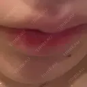 ヒアルロン酸注入（涙袋） / ヒアルロン酸注入（あご） / ヒアルロン酸注入（唇） 麻布十番クレールデンタルクリニック AFTER サムネイル用