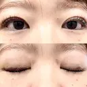 二重埋没 湘南美容クリニック 博多院 DAY 10 サムネイル用