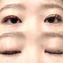 二重埋没 湘南美容クリニック 博多院 DAY 12 サムネイル用