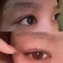 下まぶたの脂肪取り / 眉下切開 / ボトックス（額） 表参道ウィズ・クリニック DAY 13 サムネイル用