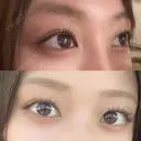 下まぶたの脂肪取り / 眉下切開 / ボトックス（額） 表参道ウィズ・クリニック AFTER サムネイル用