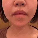 鼻翼基部形成（貴族手術） eクリニック 名古屋院 AFTER サムネイル用
