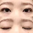 二重埋没 湘南美容クリニック 博多院 DAY 13 サムネイル用