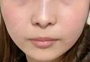 その他（輪郭） / 医療痩身（顔） / その他（肌） / RF（高周波）たるみ治療 / オンダリフト ライブリークリニック 船橋院 DAY 20 サムネイル用