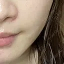 ヒアルロン酸溶解 EOL CLINIC【オルクリニック】 AFTER サムネイル用