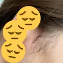 糸リフト / 骨削り（頬） View美容整形外科 DAY 3 サムネイル用