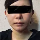 糸リフト / 脂肪吸引（顔） / 輪郭修正 / ジョールファット除去 / 脂肪吸引注射（顔） SEA CLINIC（シークリニック） AFTER サムネイル用
