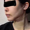 糸リフト / 脂肪吸引（顔） / 輪郭修正 / ジョールファット除去 / 脂肪吸引注射（顔） SEA CLINIC（シークリニック） DAY 3 サムネイル用