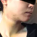 糸リフト / 脂肪吸引（顔） / 輪郭修正 / ジョールファット除去 / 脂肪吸引注射（顔） SEA CLINIC（シークリニック） DAY 3 サムネイル用