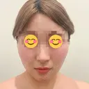糸リフト / バッカルファット除去 / 脂肪吸引（顔） / ボトックス（あご） / ボトックス（エラ・小顔） アリエル美容クリニック 水戸院 AFTER サムネイル用