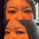 クマ治療 PRISM Beauty Clinic 町田院 AFTER サムネイル用