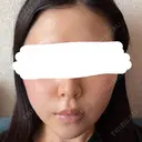 糸リフト / バッカルファット除去 / 脂肪吸引（顔） / ネックリフト / ヒアルロン酸注入（あご） / ボトックス（エラ・小顔） / ヒアルロン酸注入（唇） / ヒアルロン酸注入（鼻翼基部） / ヒアルロン酸注入（ほうれい線） HAAB×DREAM BEAUTY CLINIC 東京本院 DAY 28 サムネイル用