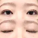 二重埋没 湘南美容クリニック 博多院 DAY 15 サムネイル用