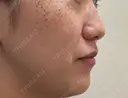 イオン導入 / ピーリング（ハリ・ツヤ） / ルメッカ ルラ美容クリニック 福岡天神院 DAY 1 サムネイル用