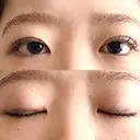 二重埋没 湘南美容クリニック 博多院 DAY 16 サムネイル用