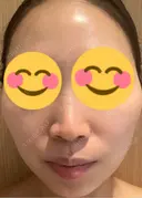 医療脱毛（顔） ルラライト美容クリニック 八王子院 DAY 0 サムネイル用