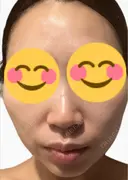 医療脱毛（顔） ルラライト美容クリニック 八王子院 DAY 1 サムネイル用