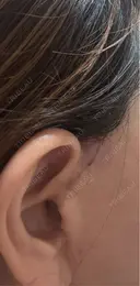 切開リフト GRACY TOKYO CLINIC【グレイシートウキョウクリニック】 AFTER サムネイル用