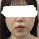 糸リフト / バッカルファット除去 / 脂肪吸引（顔） / ネックリフト / ヒアルロン酸注入（あご） / ボトックス（エラ・小顔） / ヒアルロン酸注入（唇） / ヒアルロン酸注入（鼻翼基部） / ヒアルロン酸注入（ほうれい線） HAAB×DREAM BEAUTY CLINIC 東京本院 AFTER サムネイル用