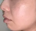 イオン導入 / 毛穴洗浄（ハイドラフェイシャルなど） / ルメッカ ルラ美容クリニック 福岡本院 AFTER サムネイル用