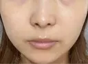 その他（輪郭） / 医療痩身（顔） / その他（肌） / RF（高周波）たるみ治療 / オンダリフト ライブリークリニック 船橋院 AFTER サムネイル用