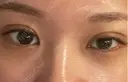 二重埋没 ルラ美容クリニック 渋谷本院 AFTER サムネイル用