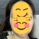 メーラーファット除去 / ジョールファット除去 R Beauty CLINIC 名古屋院 DAY 2 サムネイル用