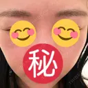 ボトックス（エラ・小顔） / ボトックス（眉間） / ボトックス（額） ルラ美容クリニック 大阪心斎橋院 AFTER サムネイル用