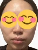 医療脱毛（顔） ルラライト美容クリニック 八王子院 DAY 3 サムネイル用