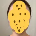 糸リフト / 骨削り（頬） View美容整形外科 DAY 4 サムネイル用