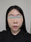 糸リフト / 脂肪吸引（顔） / メーラーファット除去 / 脂肪吸引注射（顔） SEA CLINIC（シークリニック） DAY 3 サムネイル用