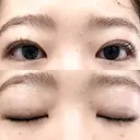 二重埋没 湘南美容クリニック 博多院 AFTER サムネイル用