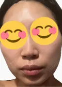 医療脱毛（顔） ルラライト美容クリニック 八王子院 DAY 4 サムネイル用