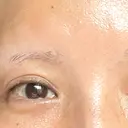 ヒアルロン酸溶解 EOL CLINIC【オルクリニック】 AFTER サムネイル用