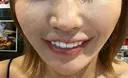 ボトックス（ガミースマイル） / ルメッカ ルラ美容クリニック 上野院 AFTER サムネイル用