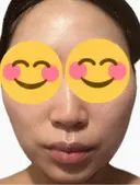 医療脱毛（顔） ルラライト美容クリニック 八王子院 AFTER サムネイル用