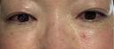 PRP皮膚再生療法 共立美容外科 名古屋院 AFTER サムネイル用