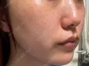 イオン導入 / ピーリング（ハリ・ツヤ） / ルメッカ ルラ美容クリニック 福岡天神院 DAY 10 サムネイル用