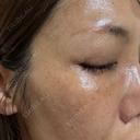 水光注射（ハリ・美肌） Natural Skin Clinic 自由ヶ丘院 DAY 4 サムネイル用
