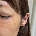 水光注射（ハリ・美肌） Natural Skin Clinic 自由ヶ丘院 AFTER サムネイル用