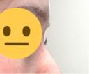 その他（鼻） ASTRA BEAUTY CLINIC DAY 8 サムネイル用
